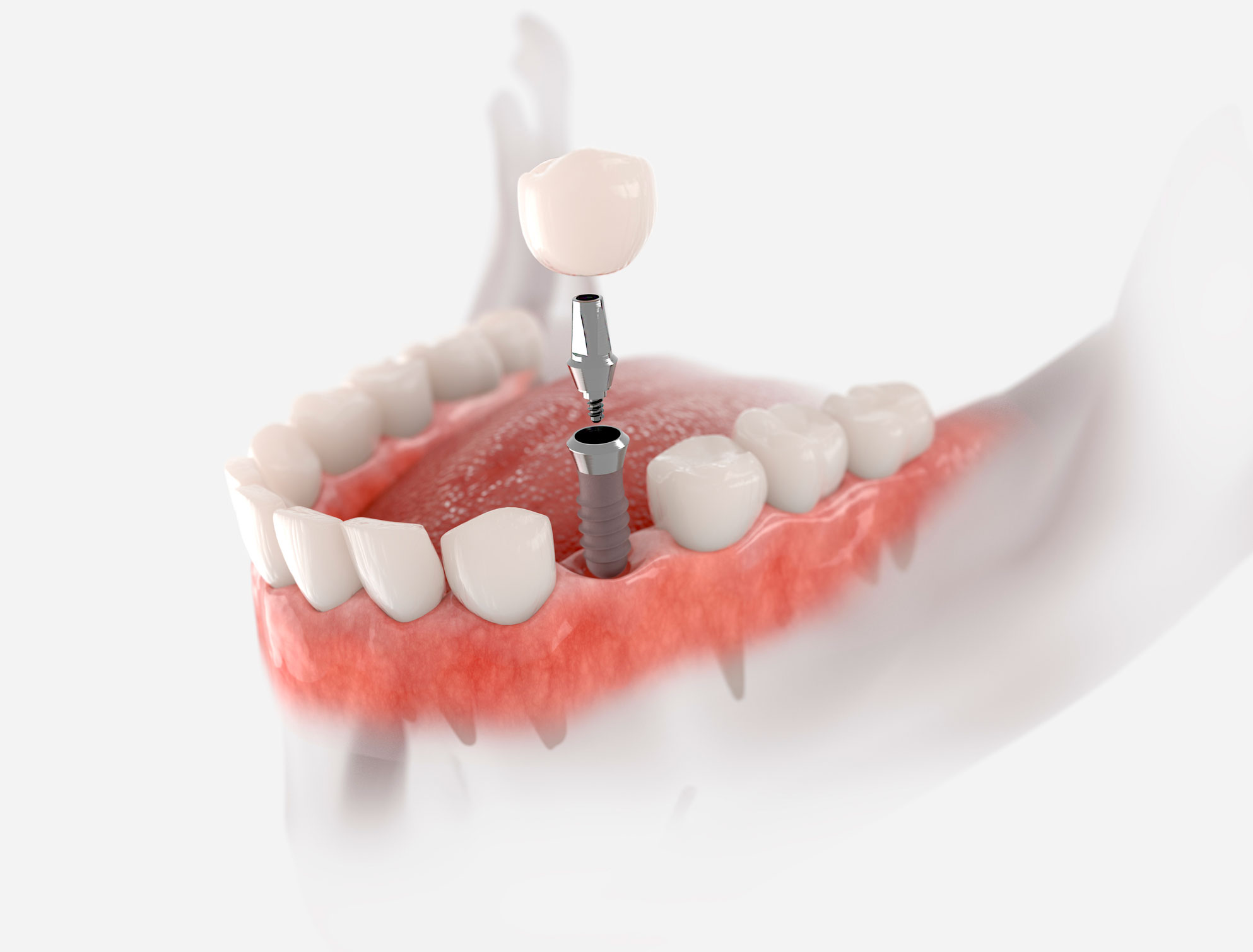 implantes dentales en Palomares del Río