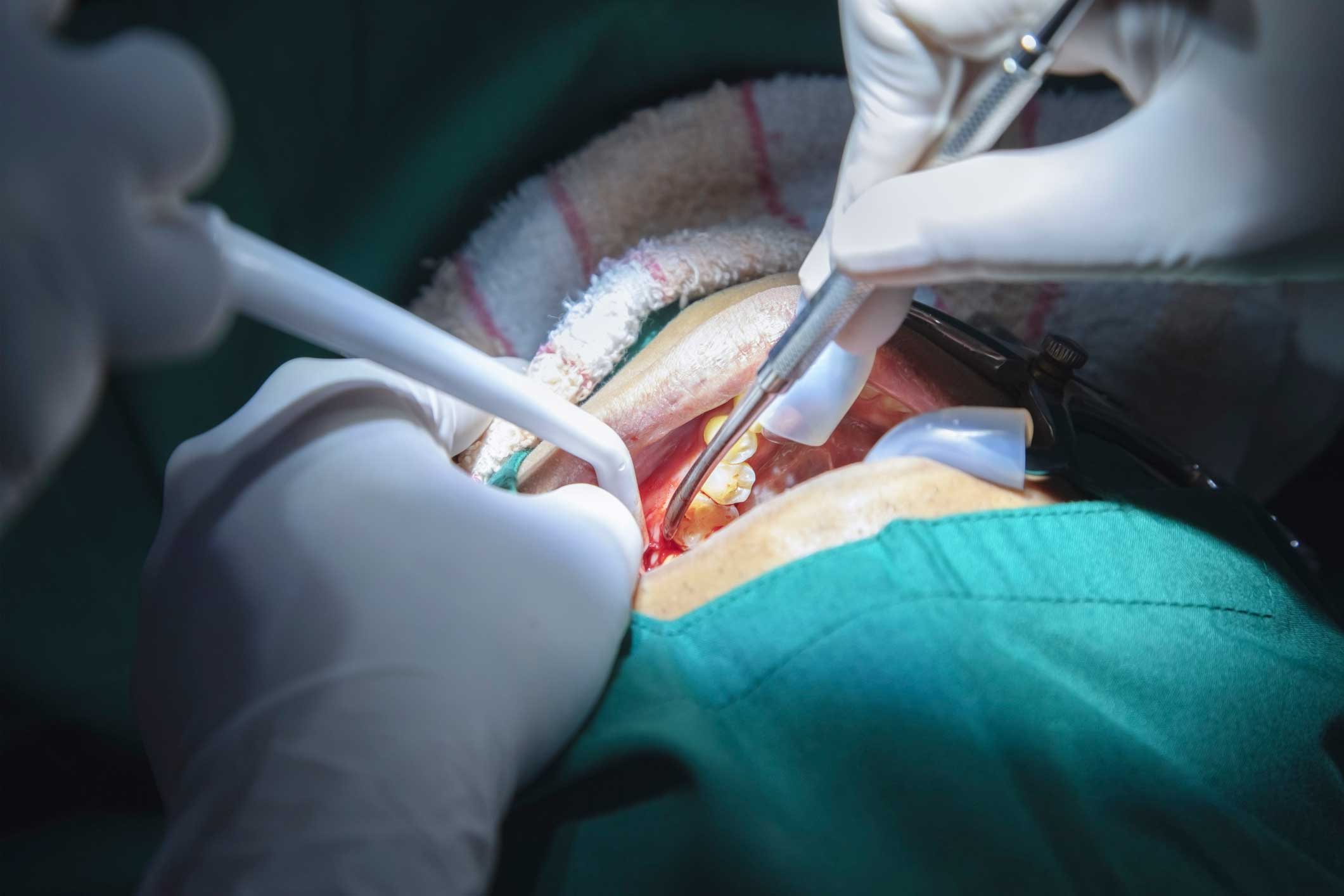 cirugía oral en Palomares del Río